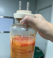 陕西水动力吸脂手术要做多久？